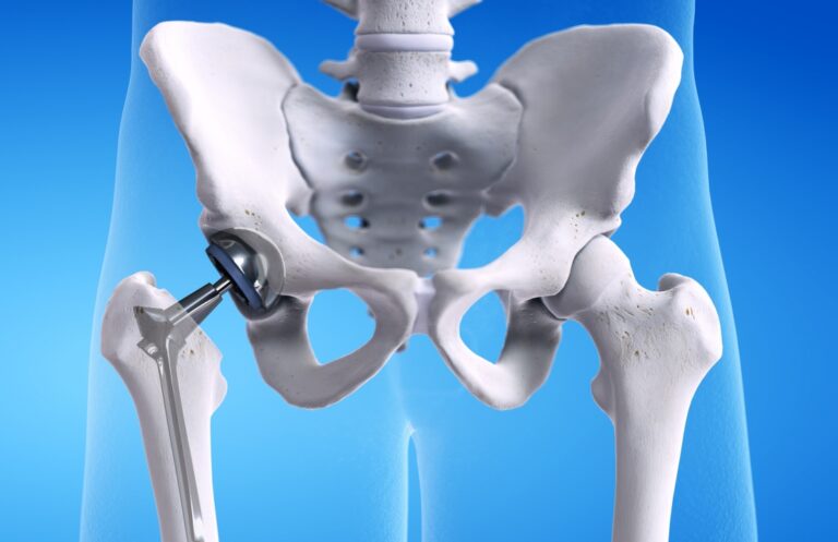 Hip Replacement Specialist in Gujarat